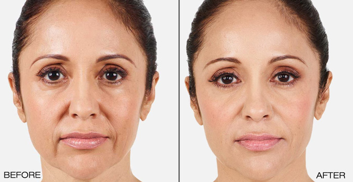 Juvederm Treatment Before After 2