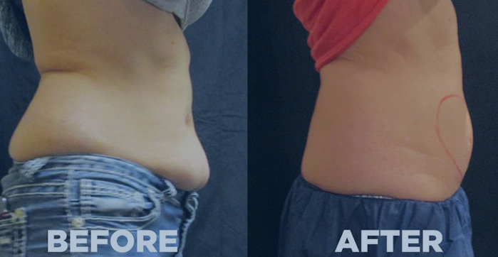 Coolsculpting Before After 1