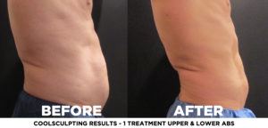 Coolsculpting Result 9